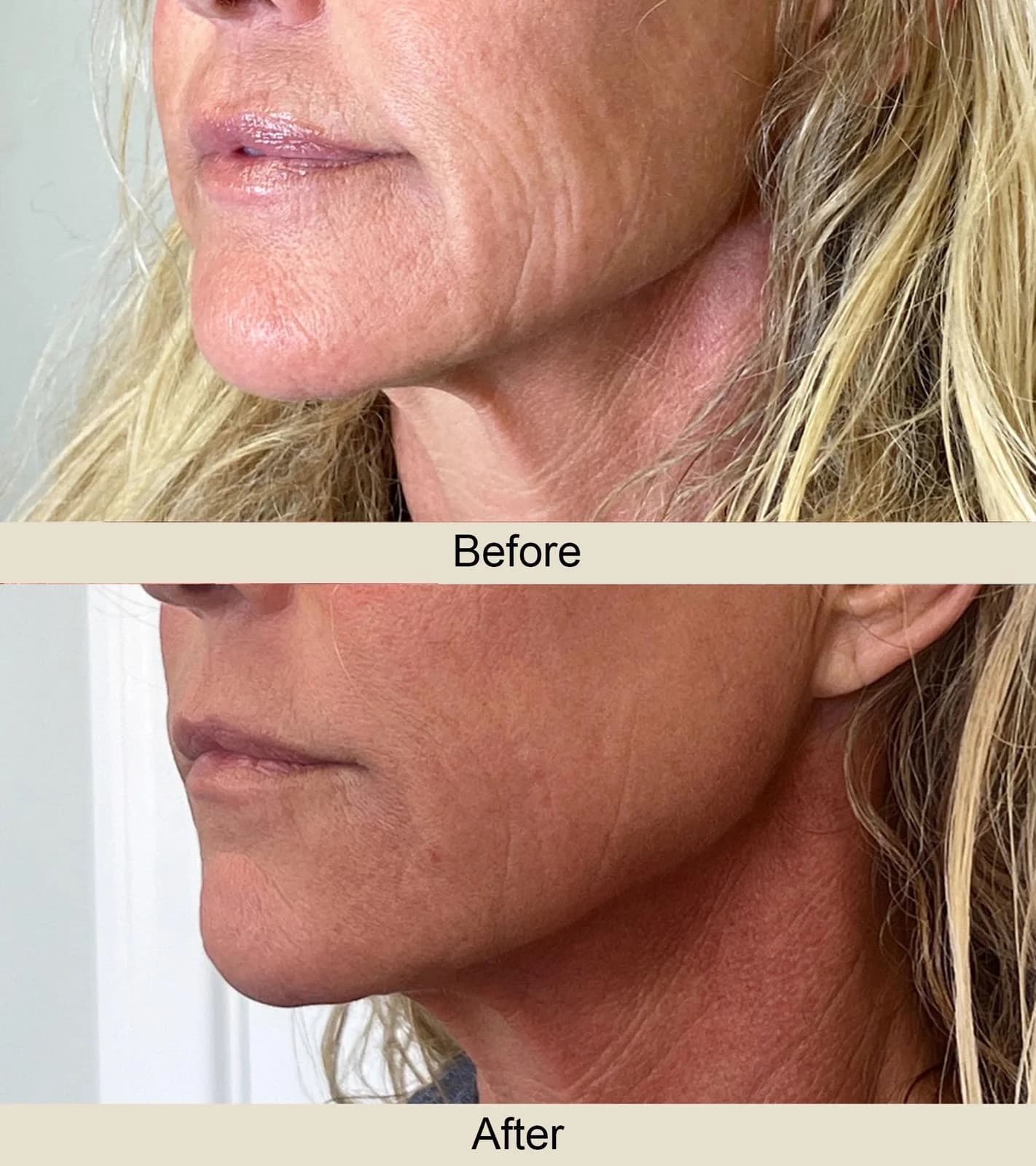 Before and after — jawline and neck lifted and tightened