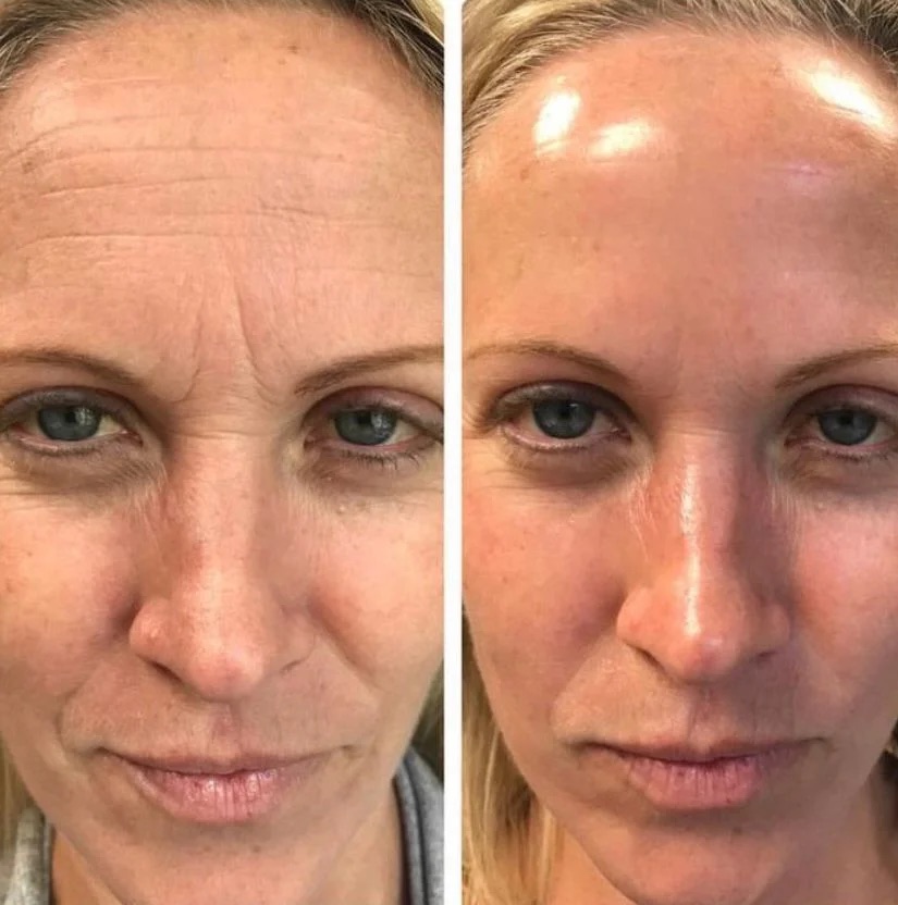 Before and after of forehead and brow lines softened with wrinkle relaxers